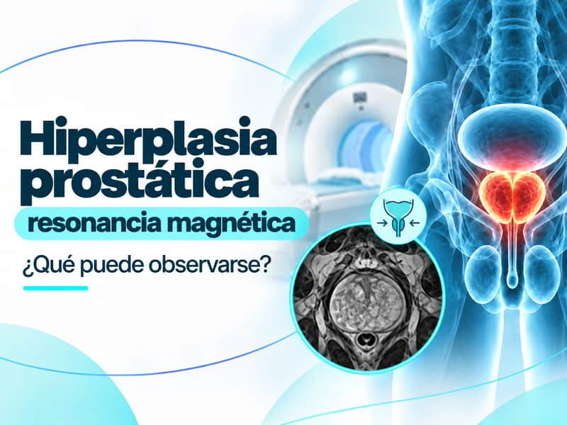 Hiperplasia prostática benigna y resonancia magnética