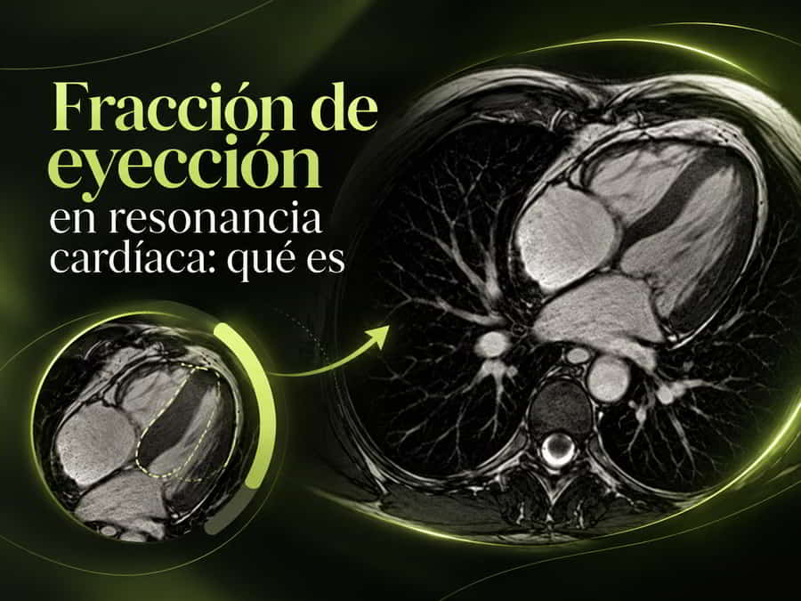 Fracción de eyección evaluada mediante resonancia magnética cardíaca