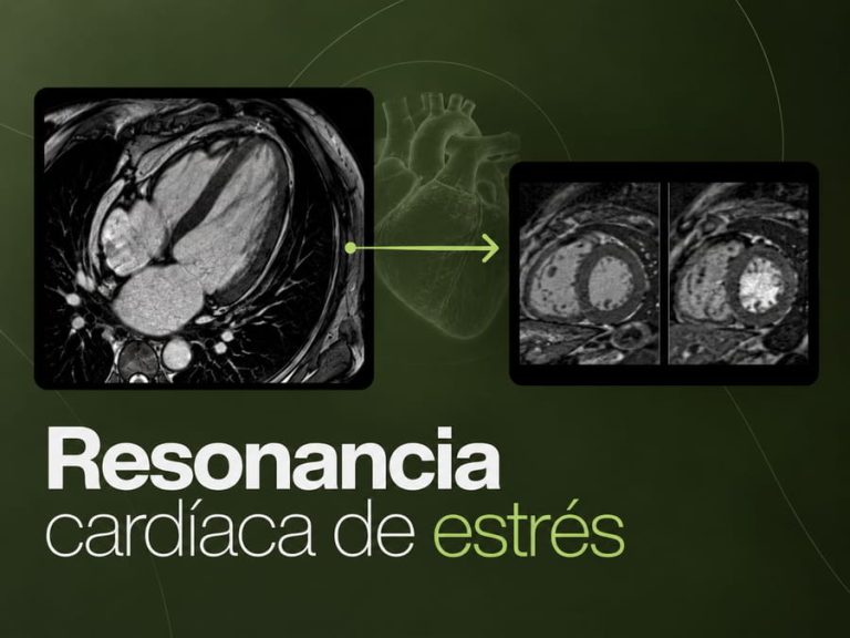 Resonancia magnética cardíaca de estrés para evaluar el flujo sanguíneo del corazón