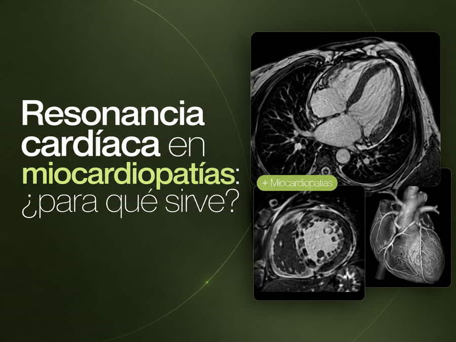 Resonancia cardíaca en la evaluación de miocardiopatías