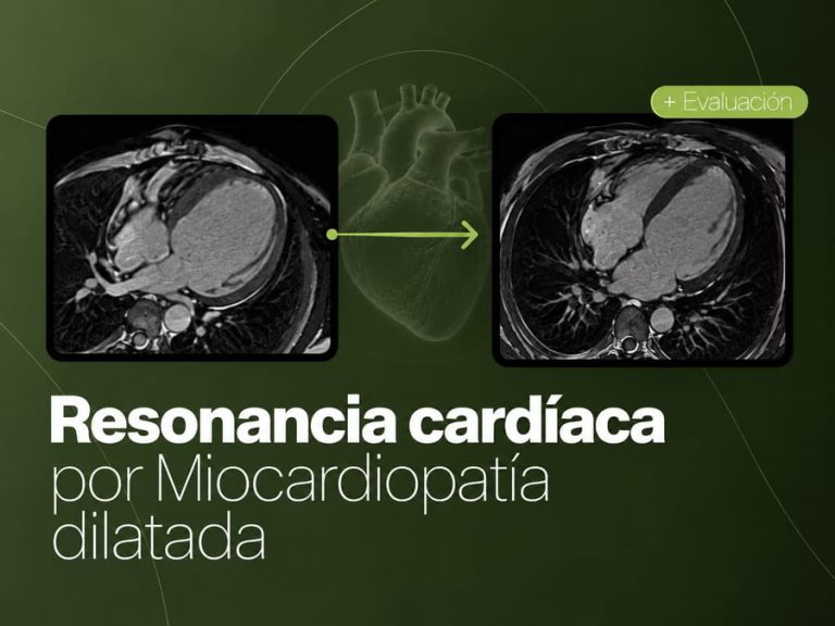 Resonancia magnética cardíaca para estudiar masas y lesiones del corazón