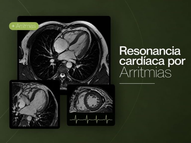Resonancia magnética cardíaca para investigar causas estructurales de arritmias
