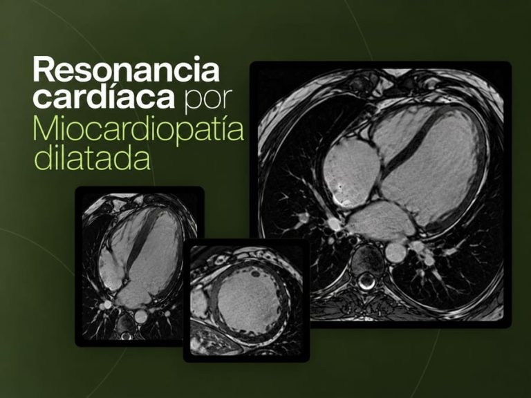 Resonancia magnética cardíaca para la evaluación de miocardiopatía dilatada