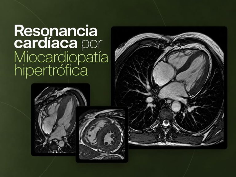 Resonancia magnética cardíaca para evaluar miocardiopatía hipertrófica