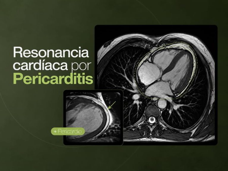 Resonancia magnética cardíaca para evaluar inflamación del pericardio en pericarditis