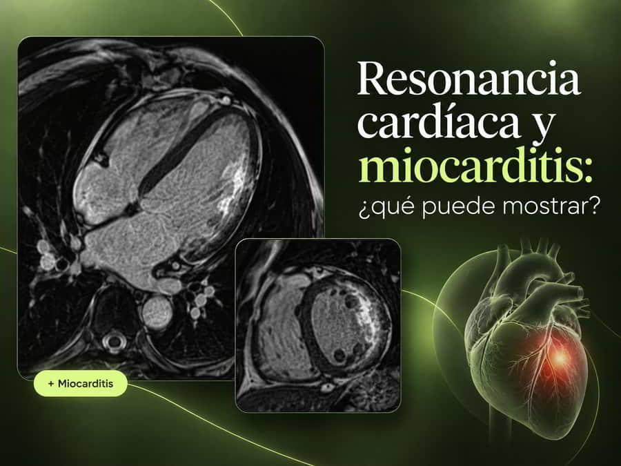 Resonancia magnética cardíaca utilizada en la evaluación de la miocarditis
