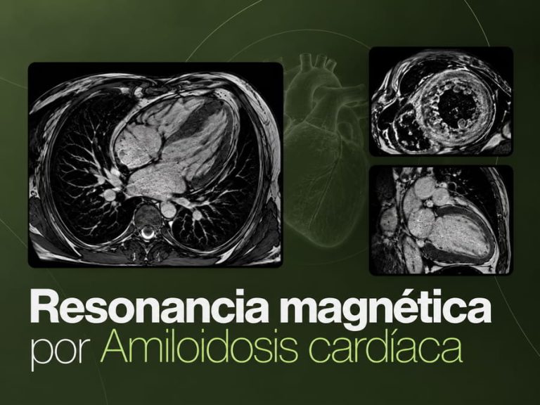 Resonancia magnética cardíaca para evaluar hallazgos de amiloidosis en el corazón